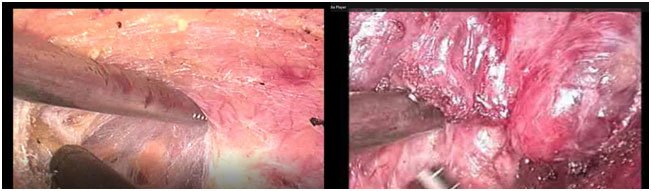 Endoscopic Thyroidectomy: BABA Technique