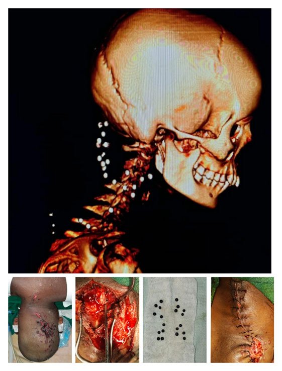 Case Of Gun Shot Injury