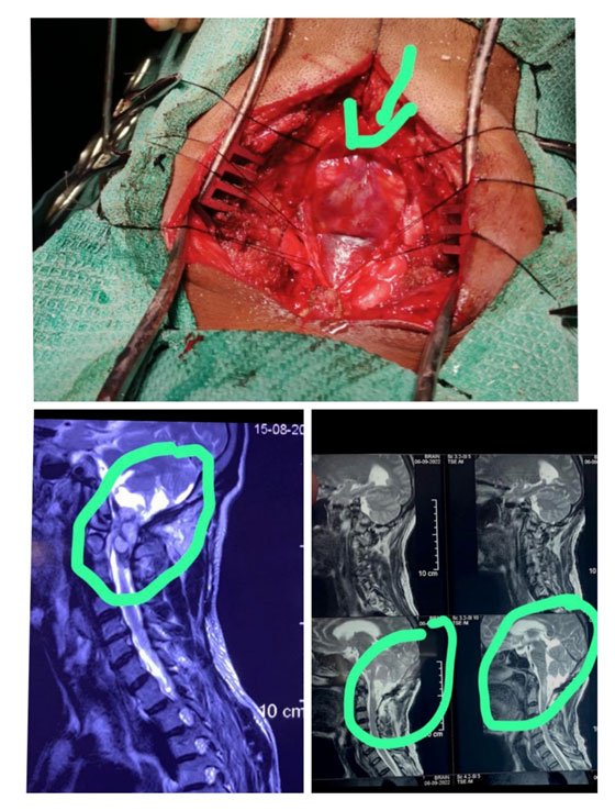 Case Of CVJ Anamoly