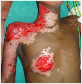Electrical Burn Reconstruction