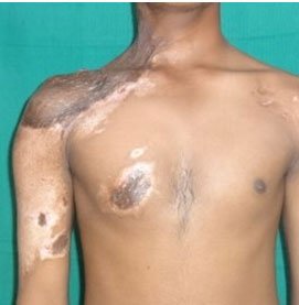Electrical Burn Reconstruction