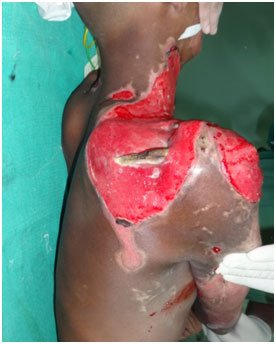 Electrical Burn Reconstruction