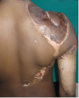 Electrical Burn Reconstruction