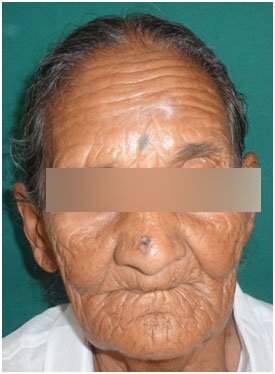 Cancer Reconstruction - BCC Nose
