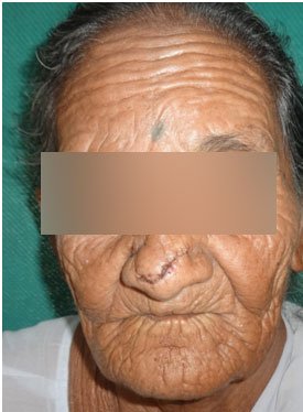 Cancer Reconstruction - BCC Nose