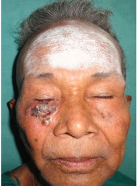 BCC Lower Eye Lid