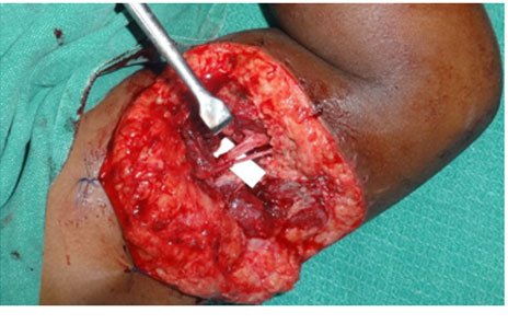 Radial Nerve Secondary Repair