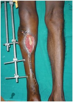 Trauma Reconstruction