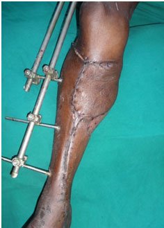 Trauma Reconstruction