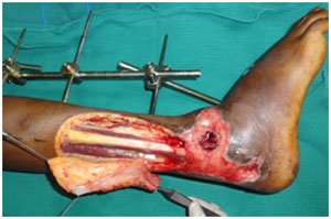 Trauma Reconstruction