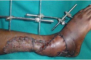 Trauma Reconstruction