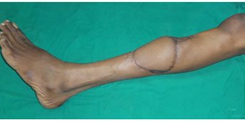Microsurgery