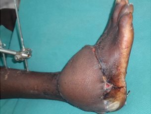 Microsurgery