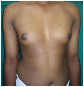Cosmetic Surgery - Gynecomastia