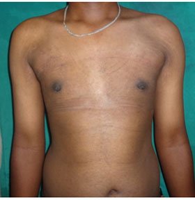 Cosmetic Surgery - Gynecomastia