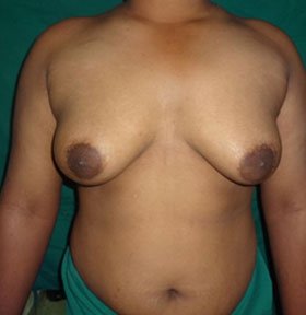 Cosmetic Surgery - Gynecomastia