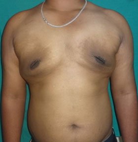 Cosmetic Surgery - Gynecomastia