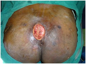 Pressure Ulcer