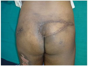 Pressure Ulcer