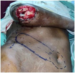 Elbow Defect Covered with Thoraco Umbilical Flap