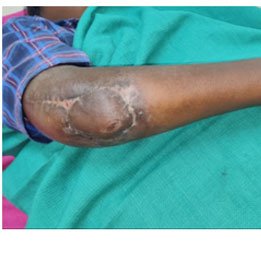 Elbow Defect Covered with Thoraco Umbilical Flap