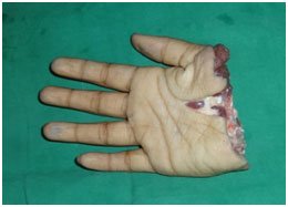 Hand Replantation