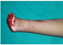 Hand Replantation