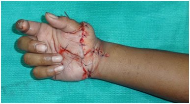 Hand Replantation