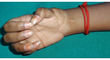Hand Replantation