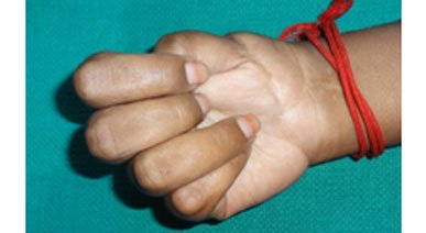 Hand Replantation