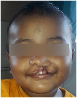 Cleft Lip Repair