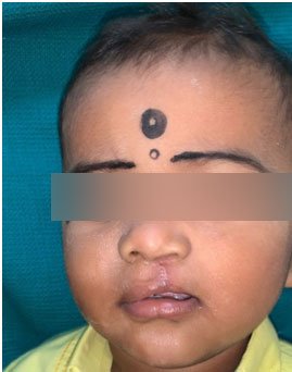 Cleft Lip Repair