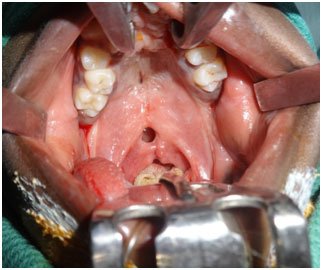 Palatal Fistula Repair