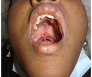 Palatal Fistula Repair