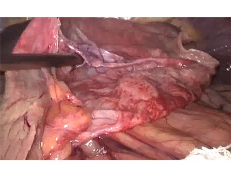 Laparoscopic Surgery for Biliary Cyst