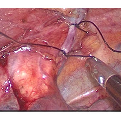 Surgery for Cancer Oesophagus