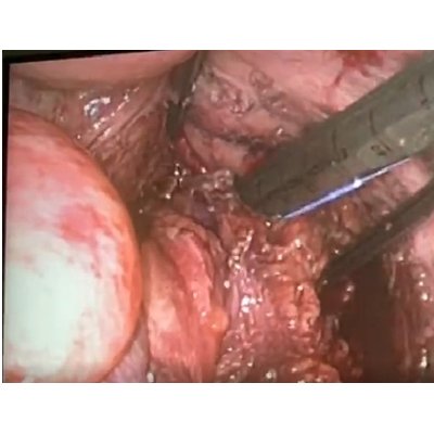 Laparoscopic Surgery for Rectal Cancer