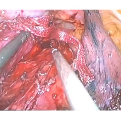 VATS for Oesophagus Cancer