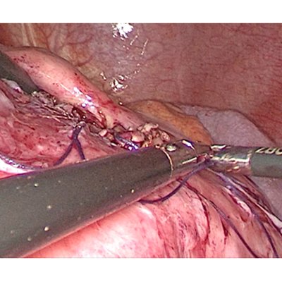 Advanced Laparoscopic Surgery
