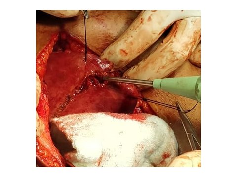 Liver resection using CUSA