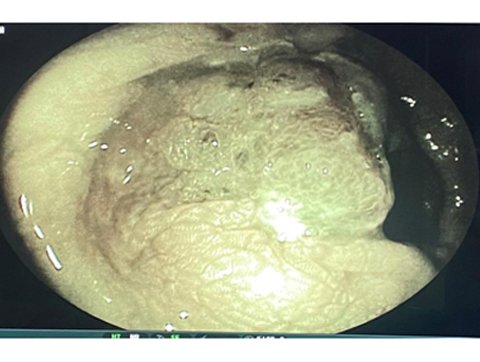 HD Endoscopy with FICE Technology