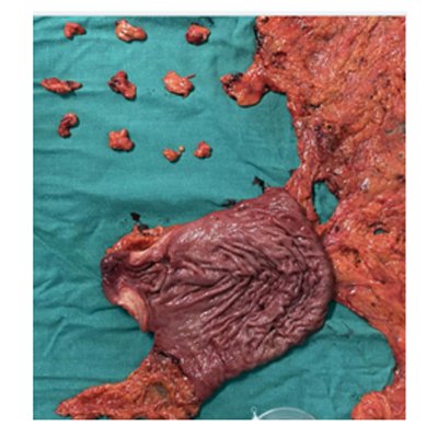 Cancer Stomach