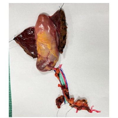 Surgery for Gall Bladder Cancer