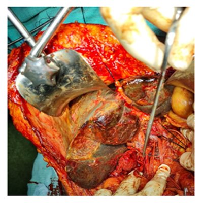 Surgery for Bile Duct Cancer