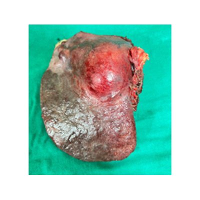 Surgery for Liver Cancer