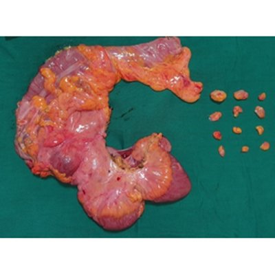 Surgery for Colon Cancer