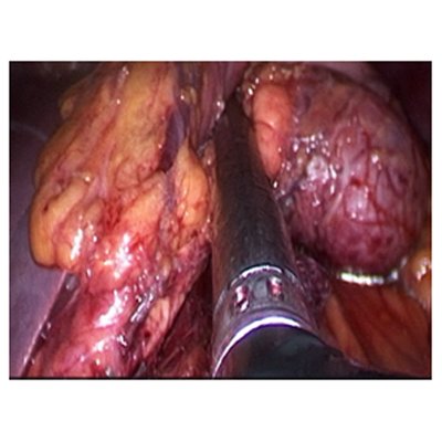Laparoscopic Surgery for Pancreatic Tumour