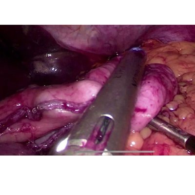 Laparoscopic Surgery for Obesity