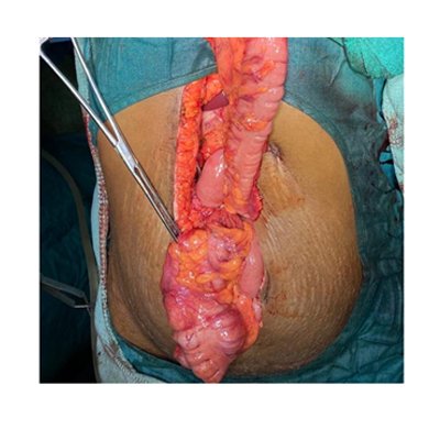 GI Reconstructive Surgery for Acid Poisoning