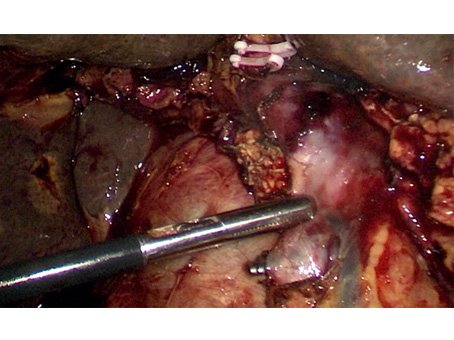 Laparoscopic Whipple's Procedure